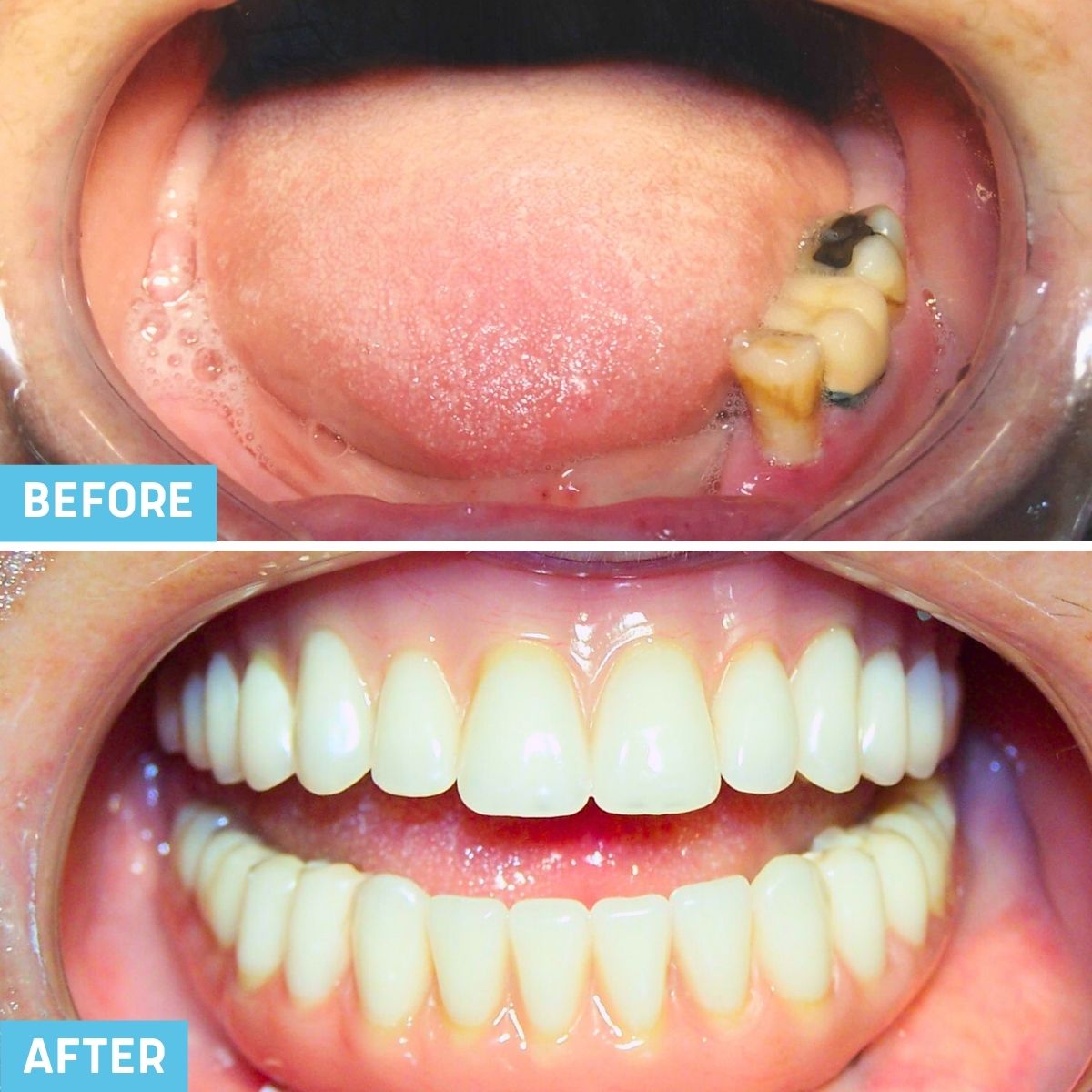 full mouth restoration with dental implants - before and after