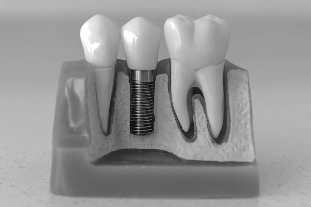 Dental implant in mouth model example