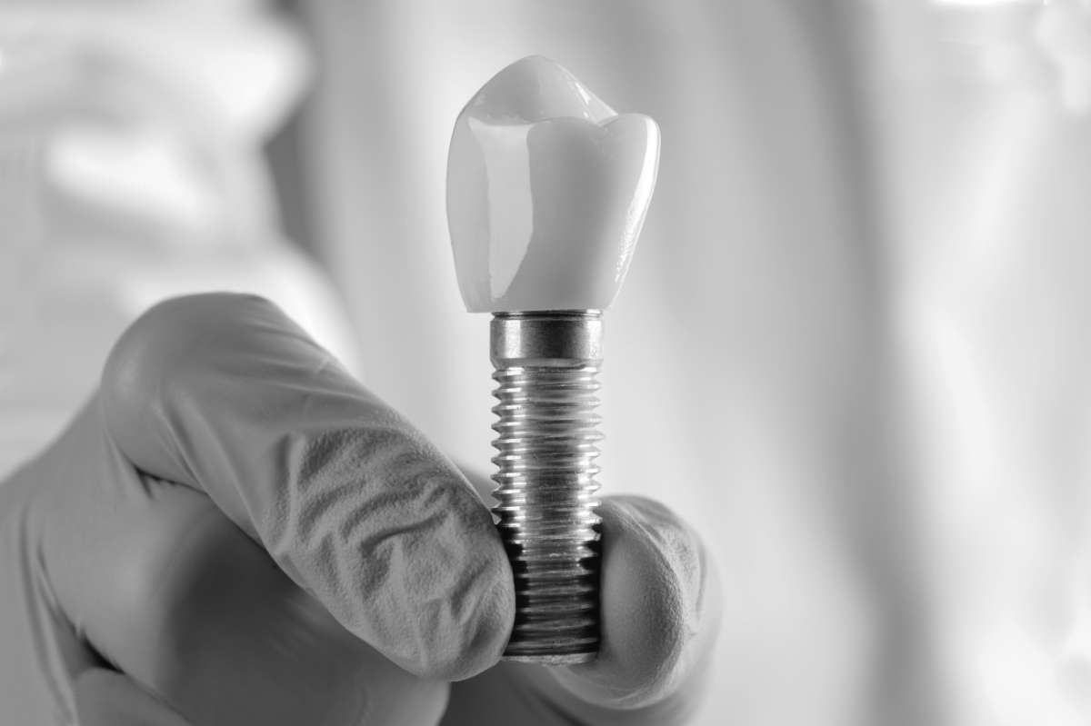 Dental Implant with a crown model that the dentist is holding in their hand.