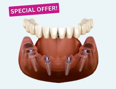 Image of all-on-4 dental implants example