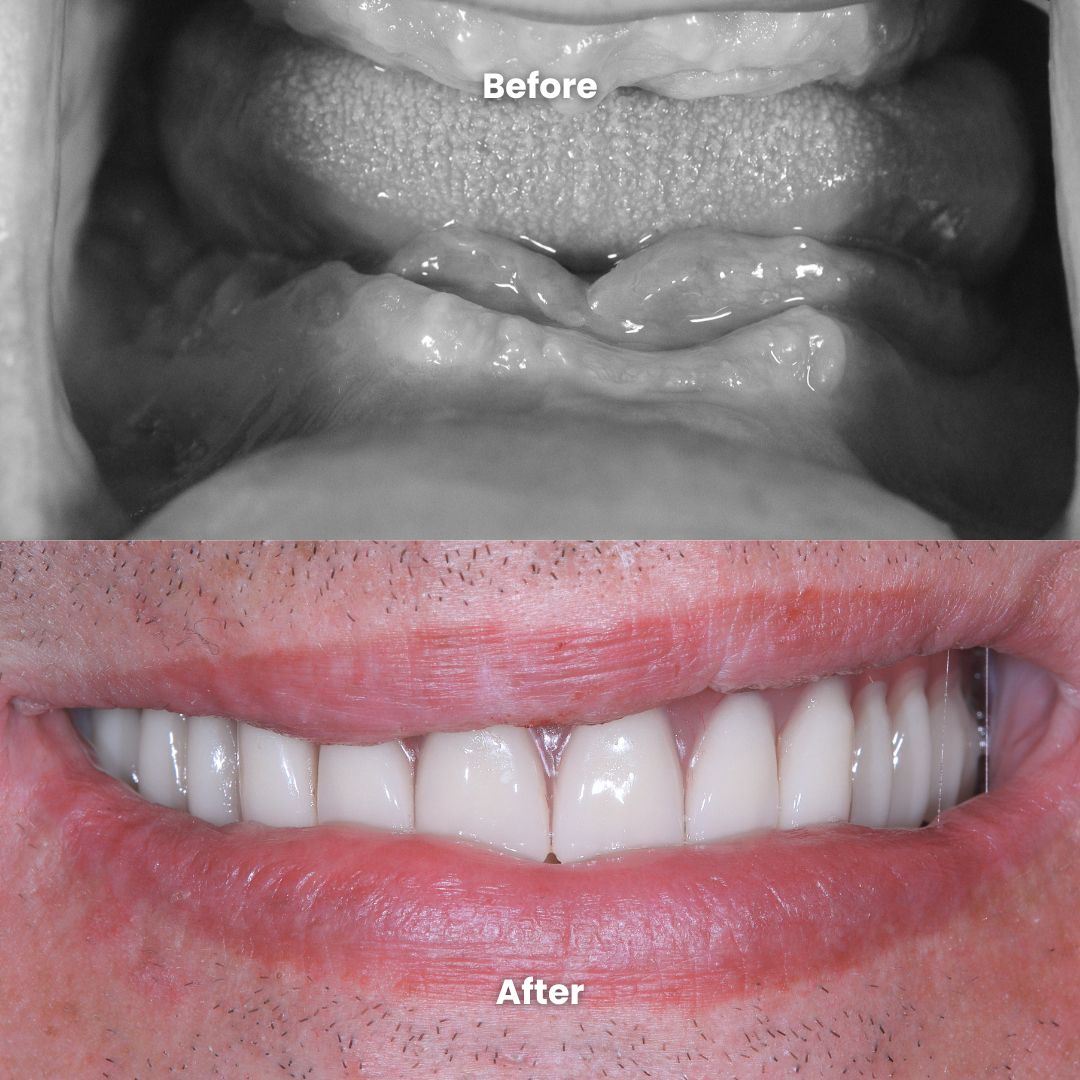 before & after full mouth restoration