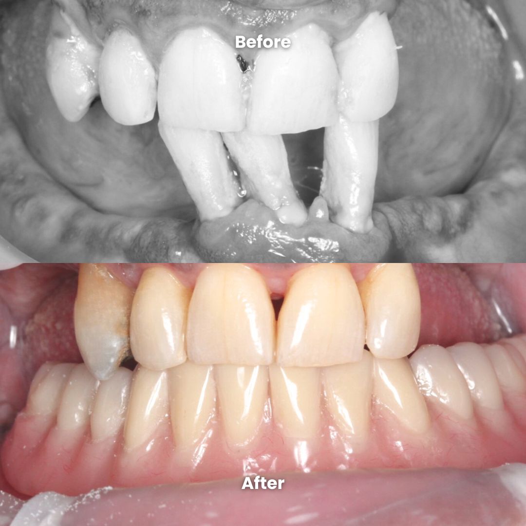 before & after full mouth restoration