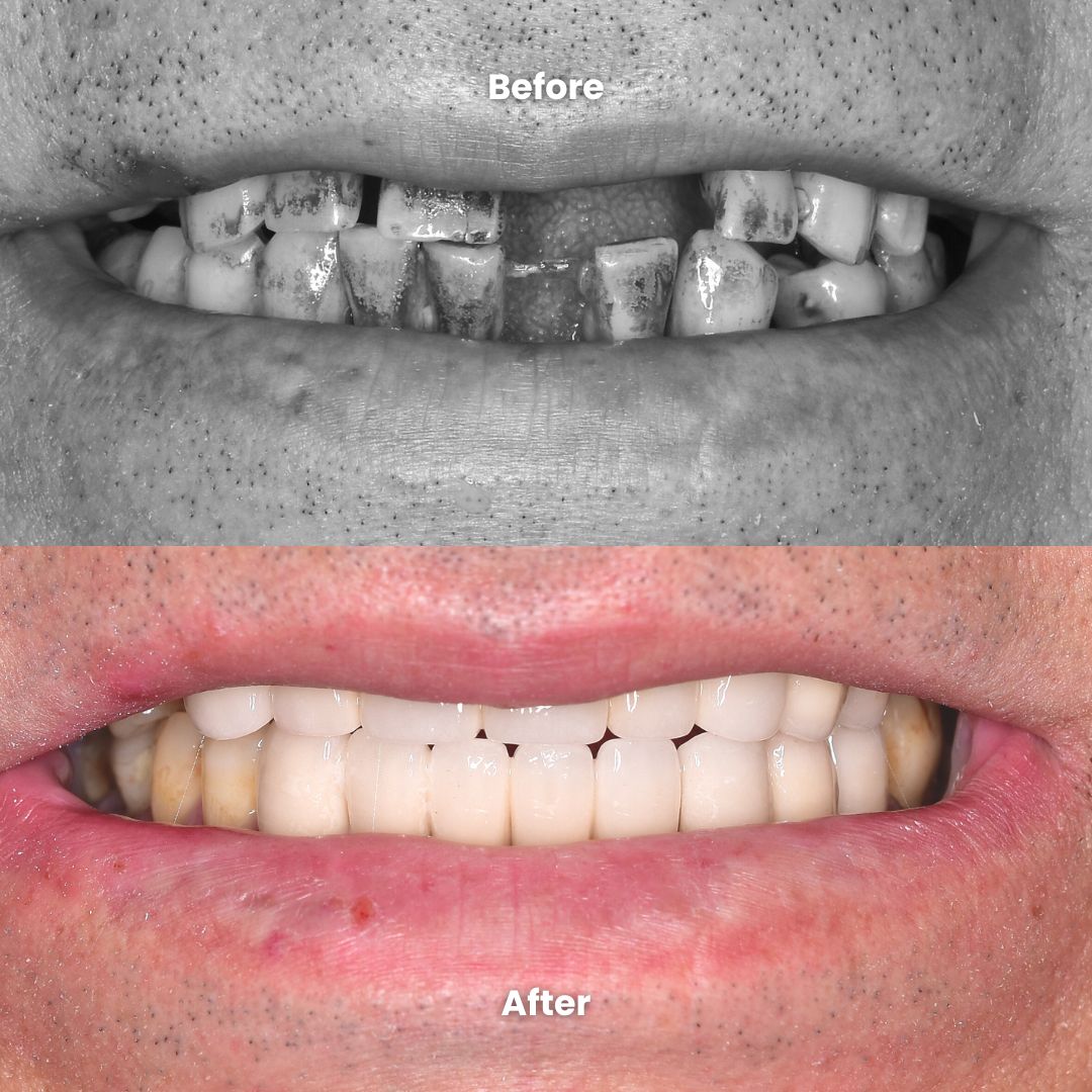 before & after full mouth restoration