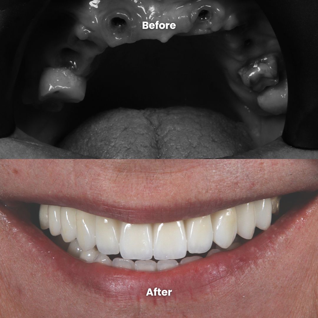 Image of all-on-6 dental implants example