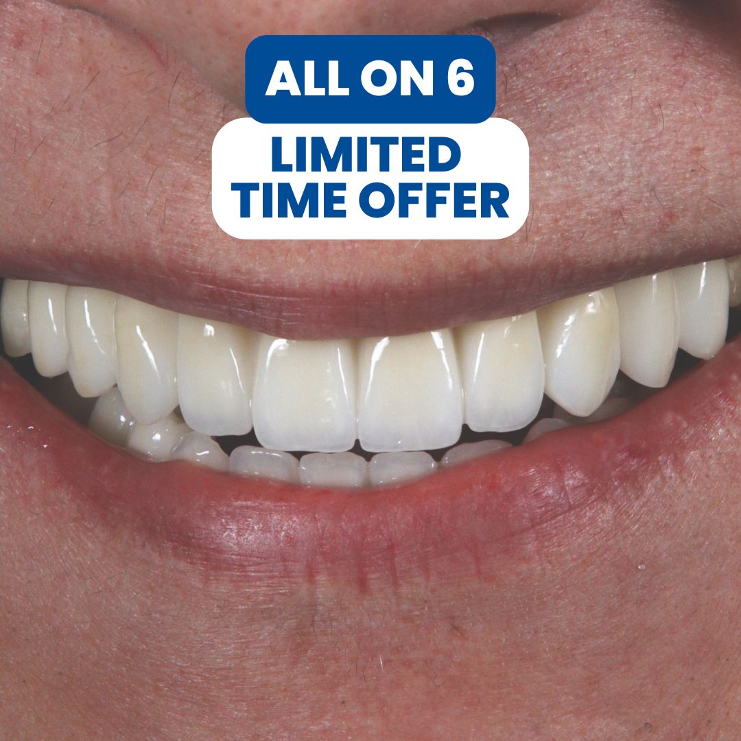 Image of all-on-6 dental implants example