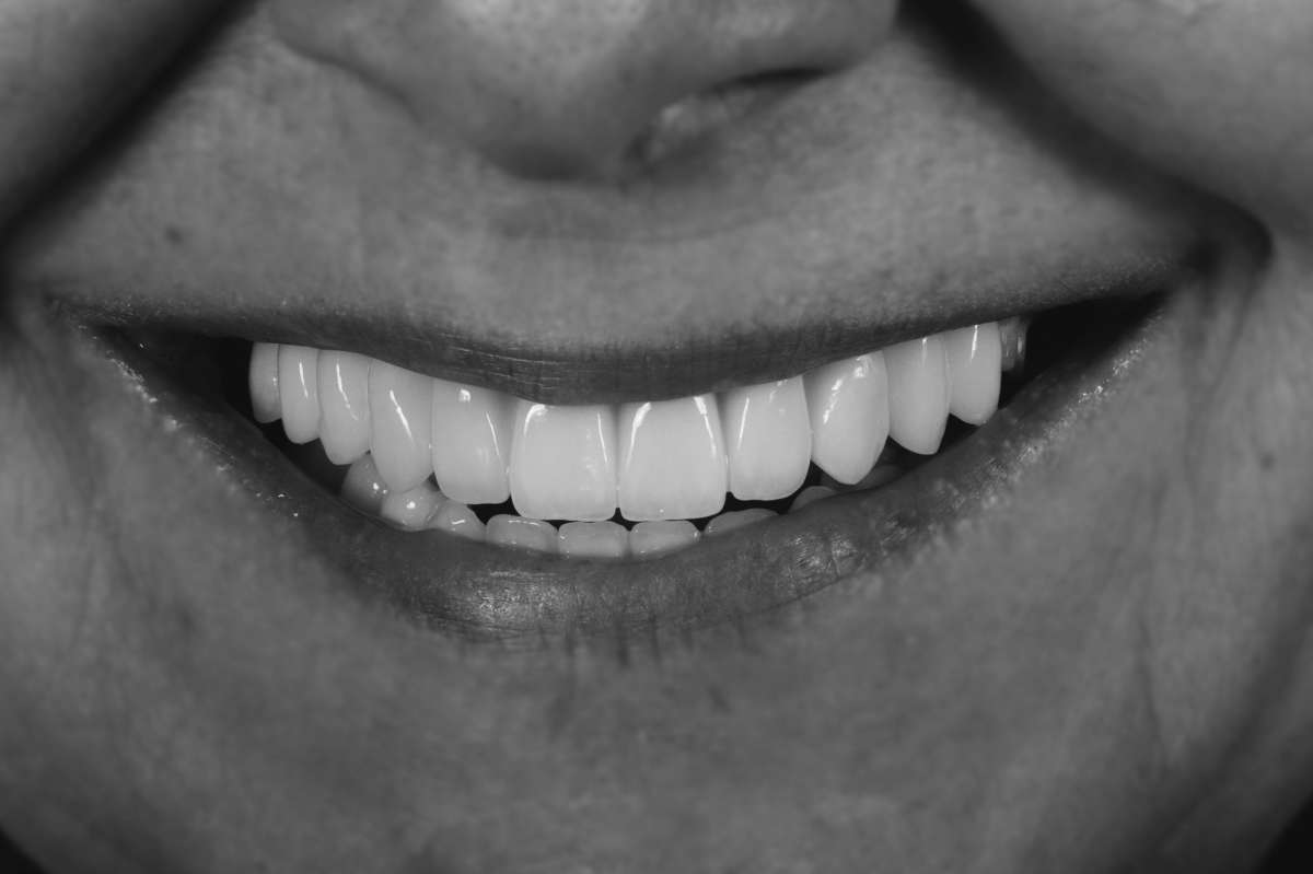 Close-up of a person's smile after a full-mouth implant treatment.